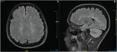 A New Report of Combined Central and Peripheral Demyelination: A Case Report